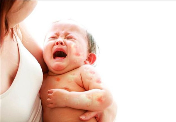Bé dị ứng đạm sữa bò: Nguyên nhân và cách khắc phục