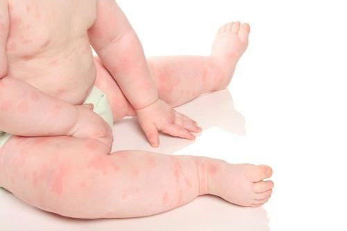 Bé dị ứng đạm sữa bò: Nguyên nhân và cách khắc phục