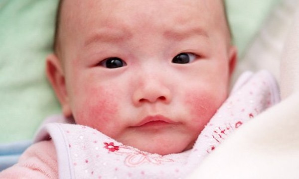 Chăm sóc da trẻ em mùa đông: Những lưu ý quan trọng
