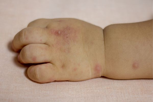 Nhận biết sớm các dấu hiệu bệnh tay chân miệng ở trẻ