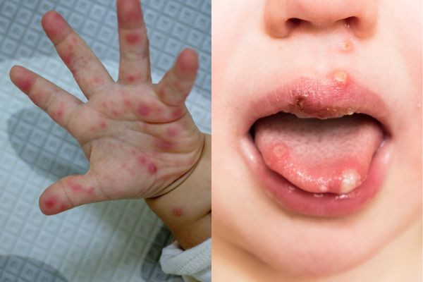 Nhận biết sớm các dấu hiệu bệnh tay chân miệng ở trẻ