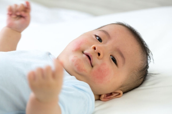 Trẻ Bị Dị Ứng Đạm Sữa Bò: Những Điều Cần Biết