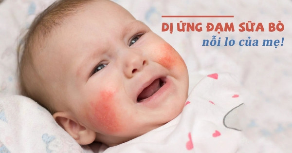 Trẻ Bị Dị Ứng Đạm Sữa Bò: Những Điều Cần Biết