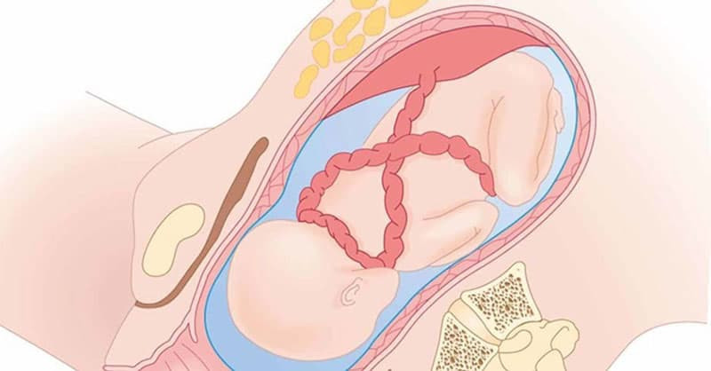 Sự thật về quan niệm mẹ bầu giơ 2 tay lên cao con sẽ bị dây rốn quấn cổ