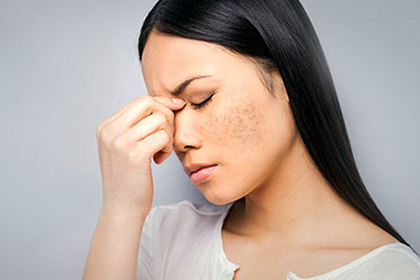 Nám Sau Sinh: Hiểu Rõ Nguyên Nhân và Cách Phòng Ngừa Hiệu Quả