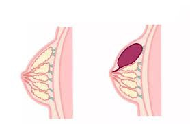 Tắc tia sữa sau sinh: Nguyên nhân và cách điều trị mẹ cần biết
