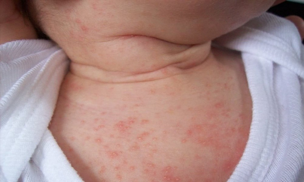 Cách Điều Trị Rôm Sảy Ở Trẻ: Hướng Dẫn Dành Cho Các Bậc Phụ Huynh