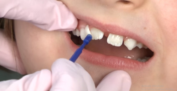 Thiếu Sản Men Răng Ở Trẻ: Nguyên Nhân, Triệu Chứng và Cách Phòng Ngừa