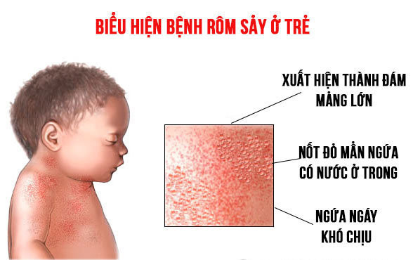 Rôm Sảy Ở Trẻ Sơ Sinh: Nguyên Nhân, Triệu Chứng và Cách Điều Trị