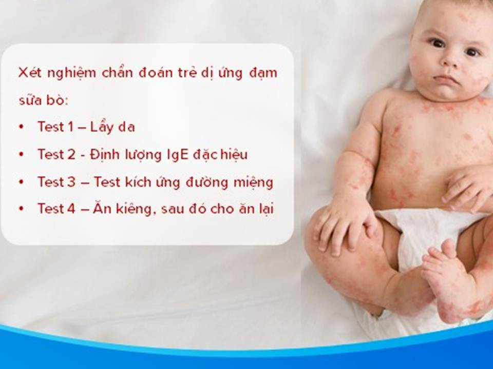 Trẻ dị ứng đạm sữa bò: Biện pháp chẩn đoán và cách xử trí