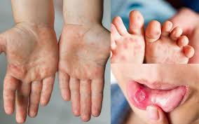 Các bệnh thường gặp của bé yêu vào mùa hè (phần 2)