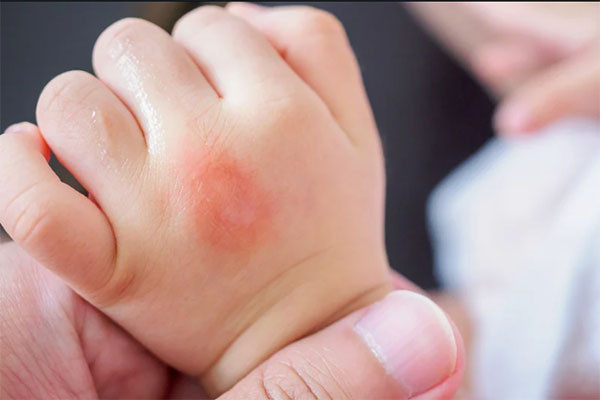 Mách mẹ chống muỗi cho bé đúng cách