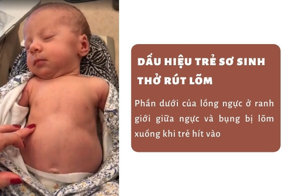 Viêm phổi ở trẻ sơ sinh và trẻ nhỏ dưới 06 tháng